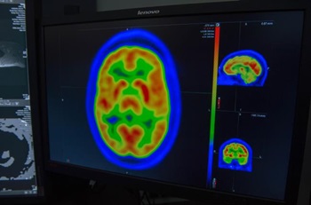 Brain Tumor